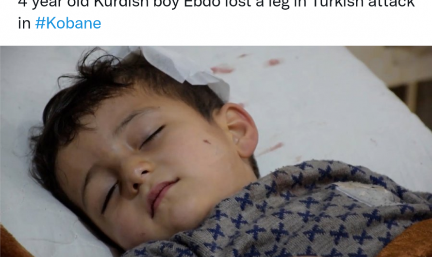 Northeast Syria: Four-year-old Ebdo lost a leg in Turkish attack