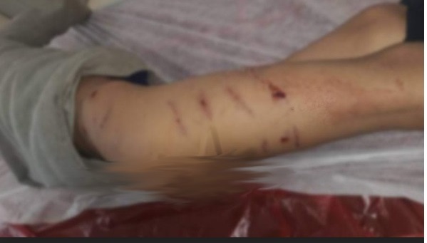 كلاب بوليسية تركية تنهش طفلا سورياً