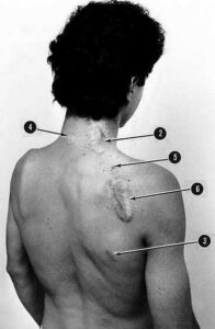 هيبت أتشيكوز